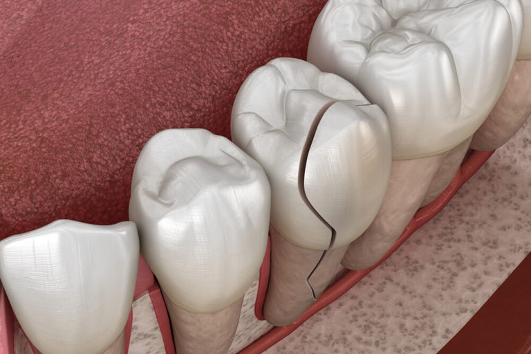 Illustration of a row of teeth with a middle tooth showing enamel damage and cracking