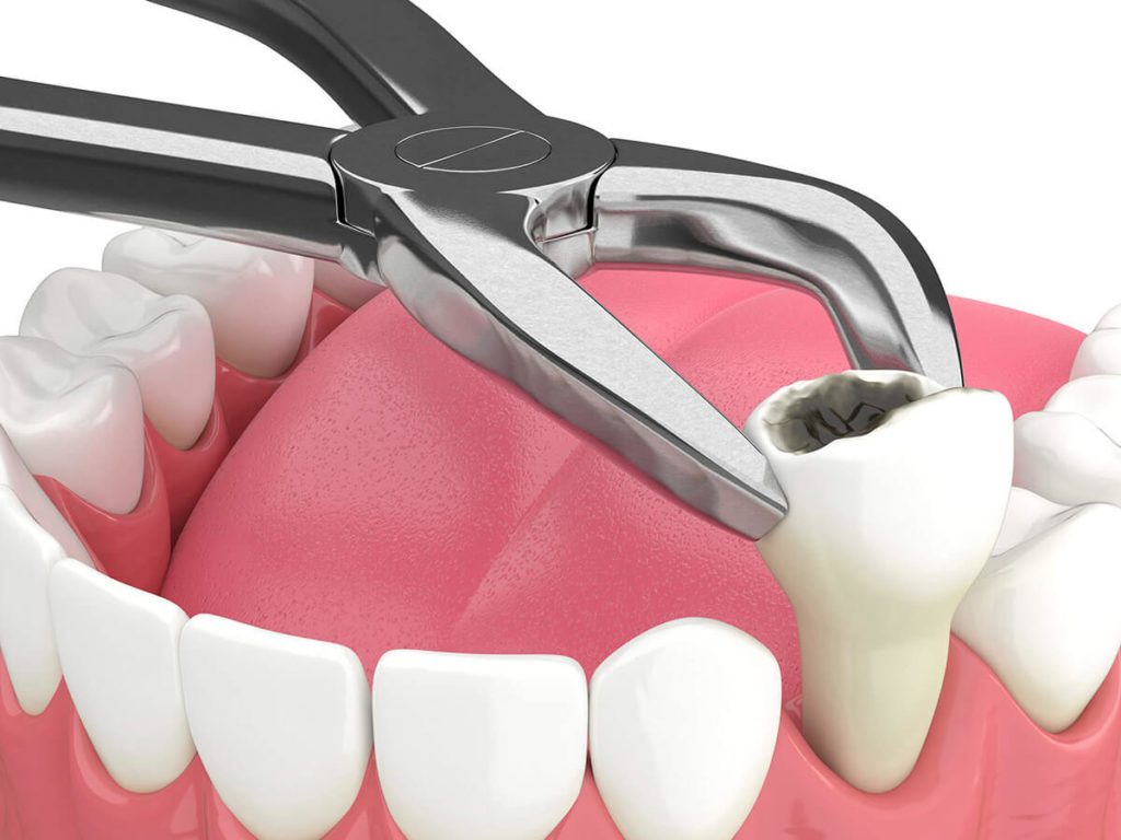 Illustration of a tooth being extracted with dental forceps